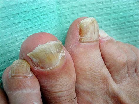 ugly feet pics|Ouch! 7 nasty foot flaws and how to fix them。